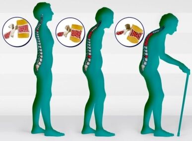 Osteoporoos